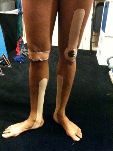 Combination of kinesiotaping and McConnell taping to help a performer
