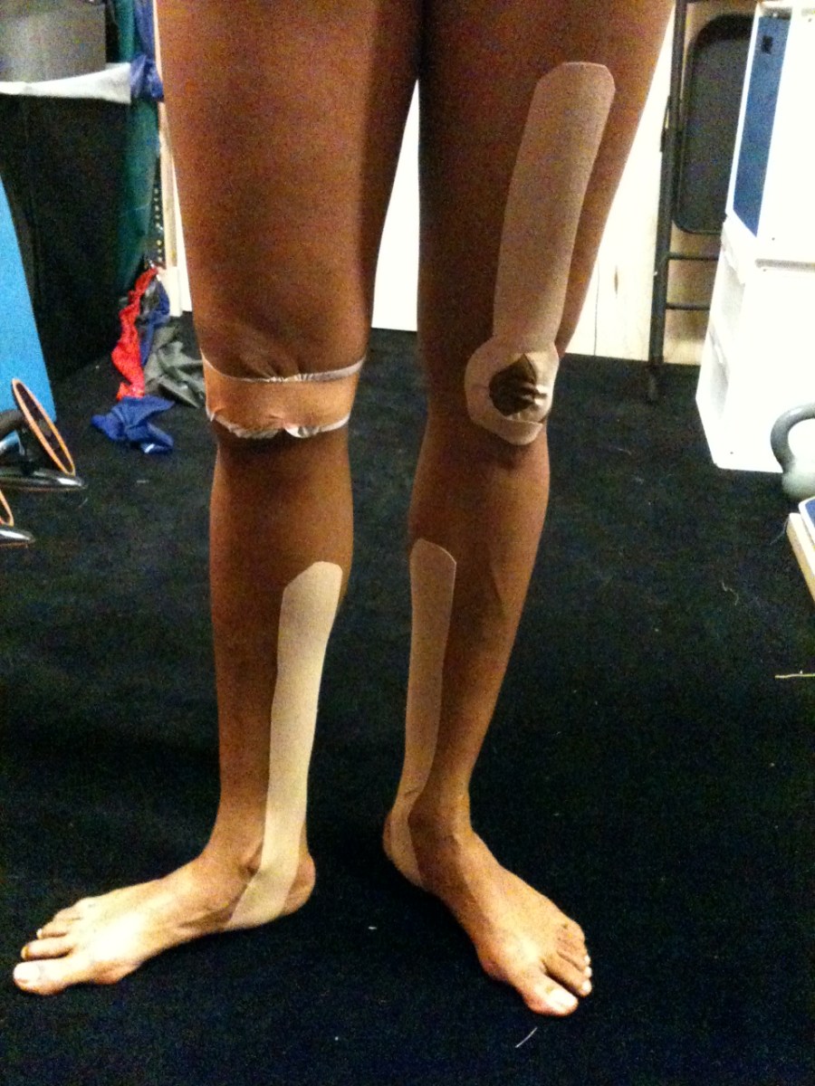Combination of kinesiotaping and McConnell taping to help a performer