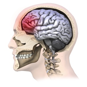 All concussions are serious injuries. Photo credit: The Physical Therapy Institute http://bit.ly/18Qpw2i 